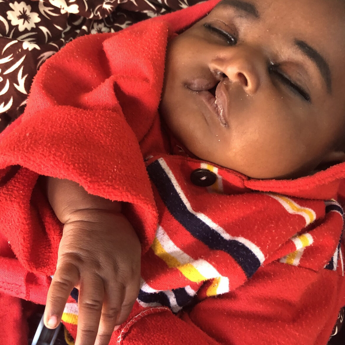 Cleft baby, Egypt Alliance for Smiles