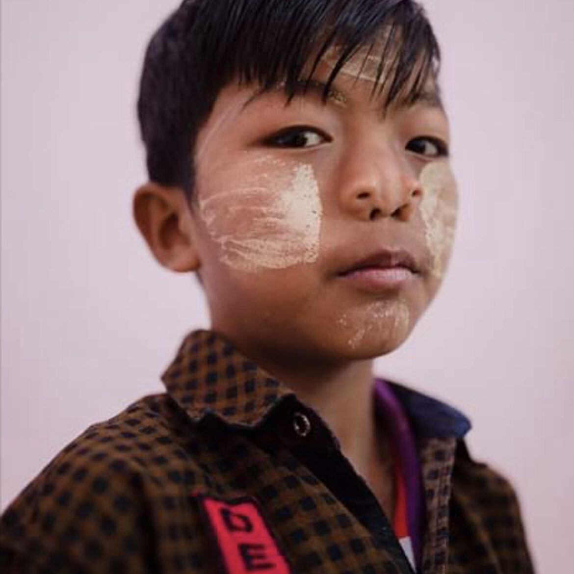 Myanmar, boy with 4 nostrils pre-surgery